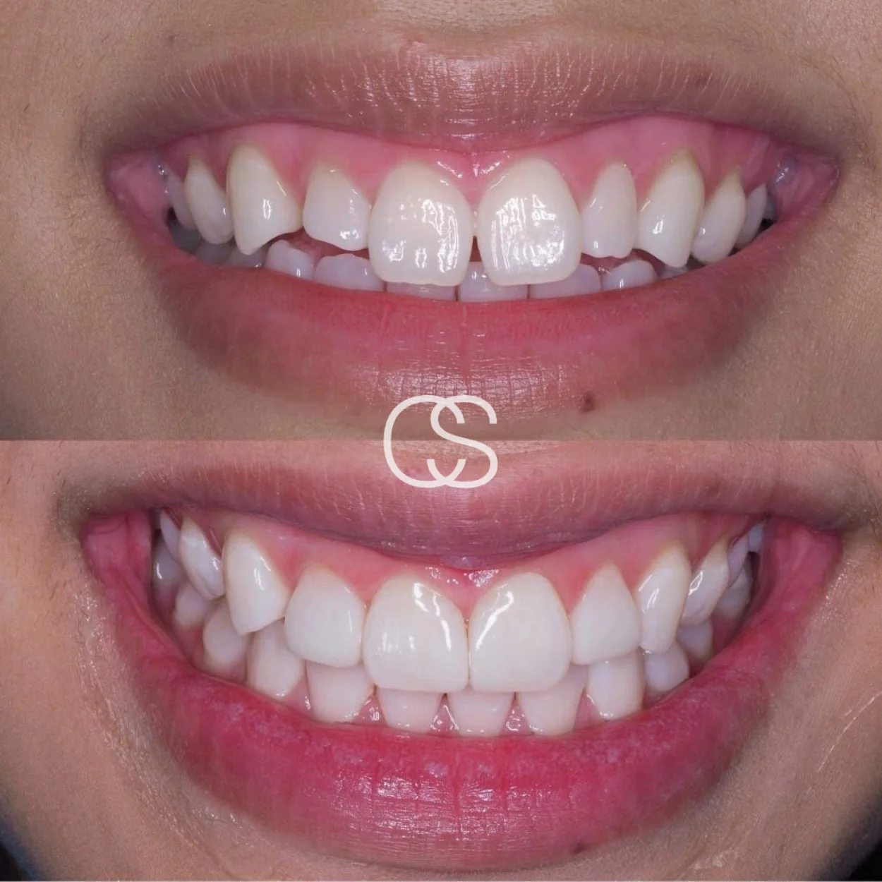 Before & After composite bonding at Colac Smiles, Colac