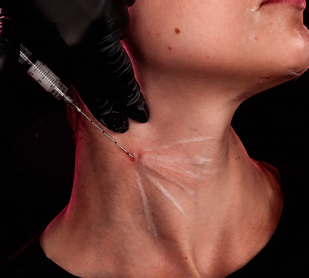 Fotografia clínica de procedimento estético no pescoço. Profissional com luvas pretas aplicando injeção para tratamento de flacidez cervical, com marcações de vetores de sustentação em branco desenhados na pele da paciente. Fundo escuro.