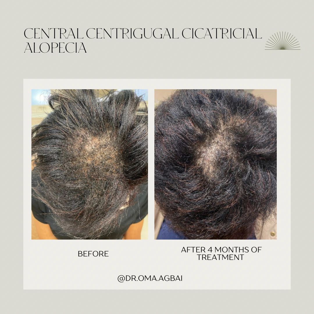 Central centrifugal cicatricial alopecia: before treatment on the left; after 4 months on the right.