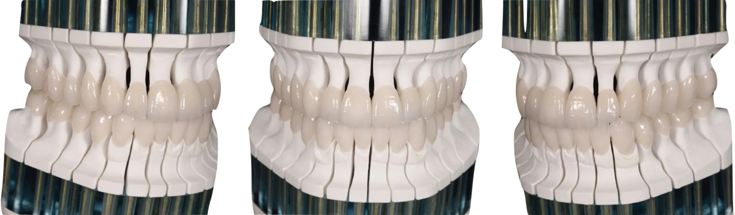 Final hand-made ceramic restorations