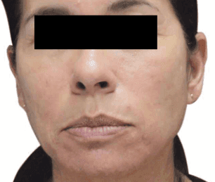 After RF microneedling - Scar Remodelling