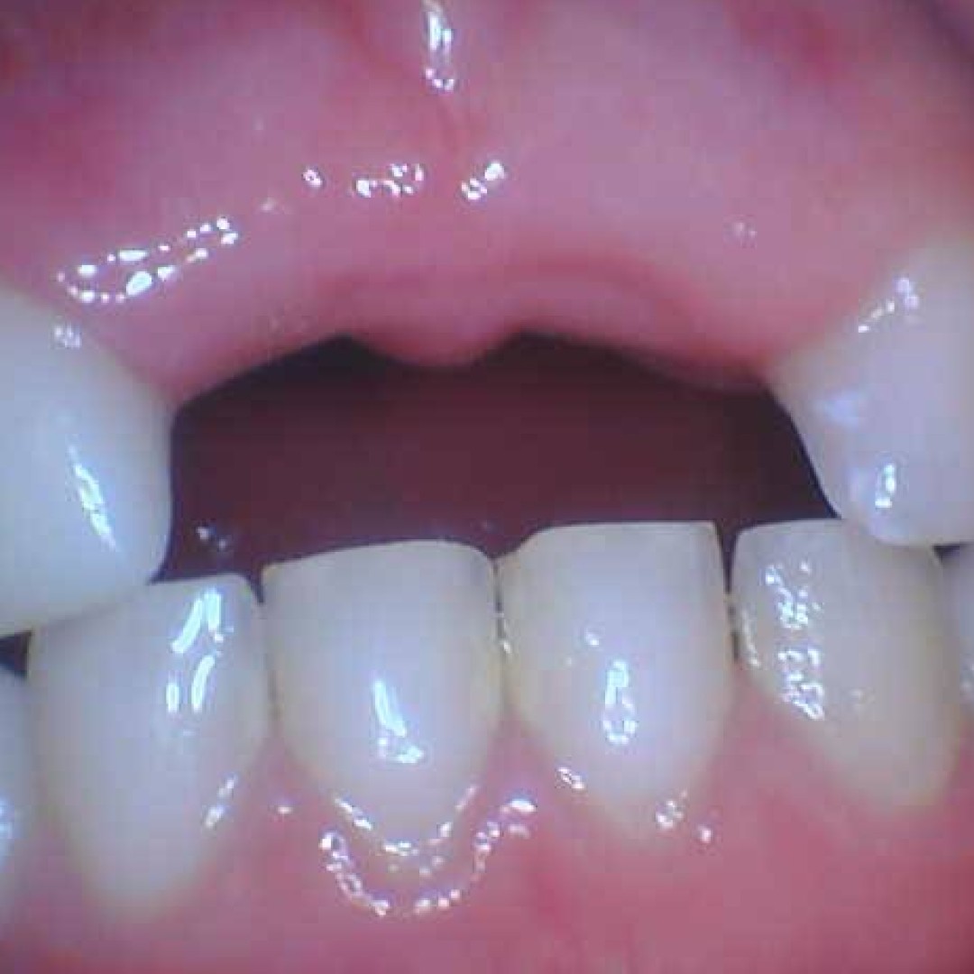 Clinical view of a missing baby tooth area, demonstrating how we maintain space for permanent tooth growth.