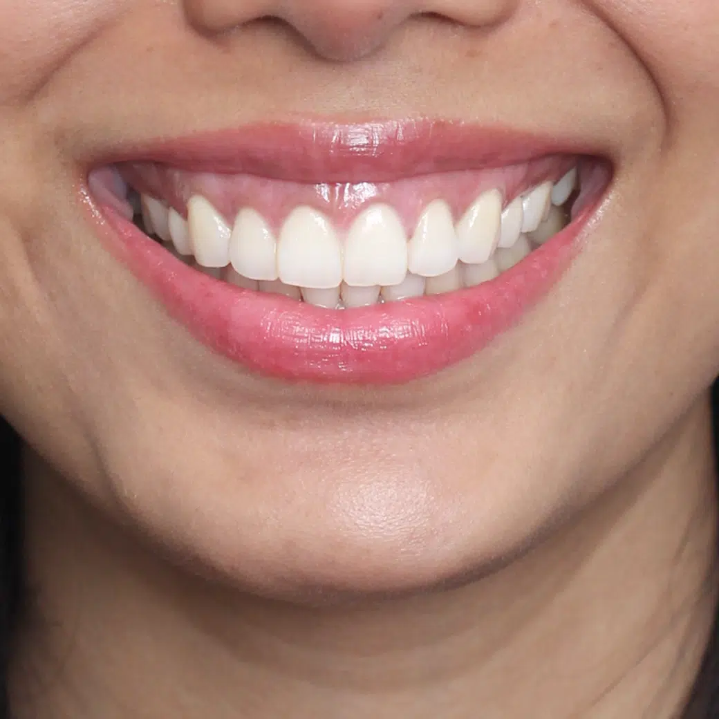 Laser gum bleaching treatment for pink gums at COSDENT Smile Design