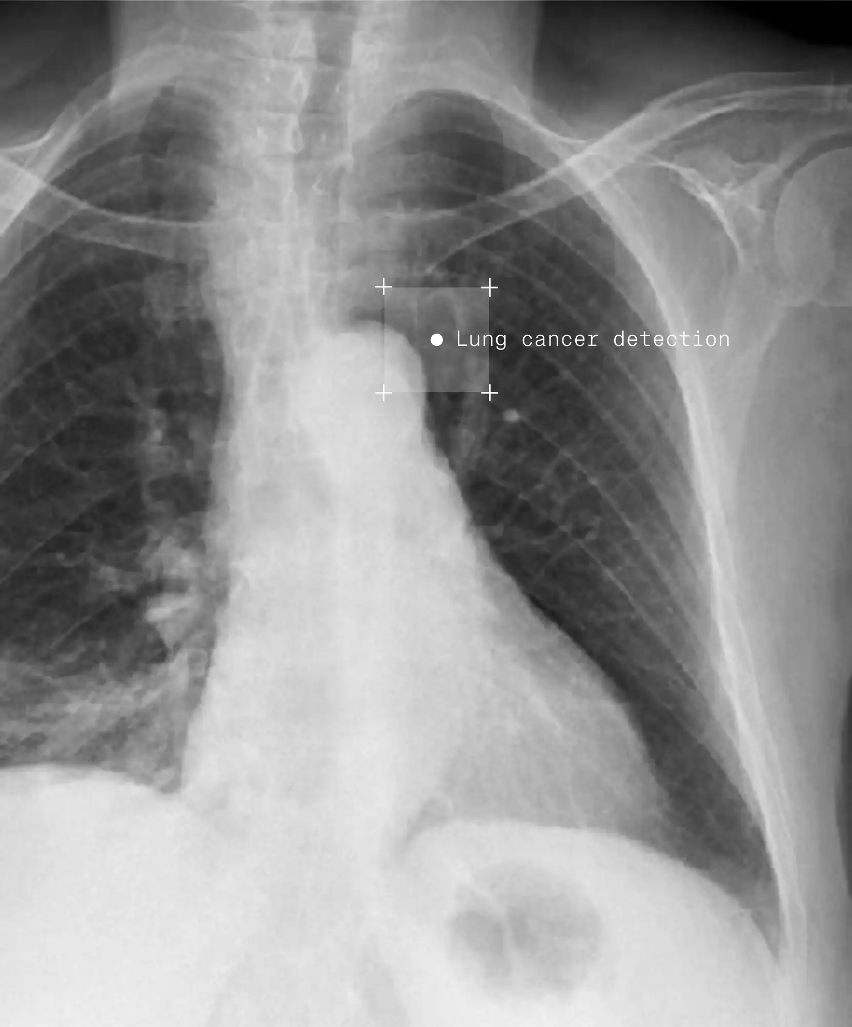 Lung Cancer detection from an X Ray