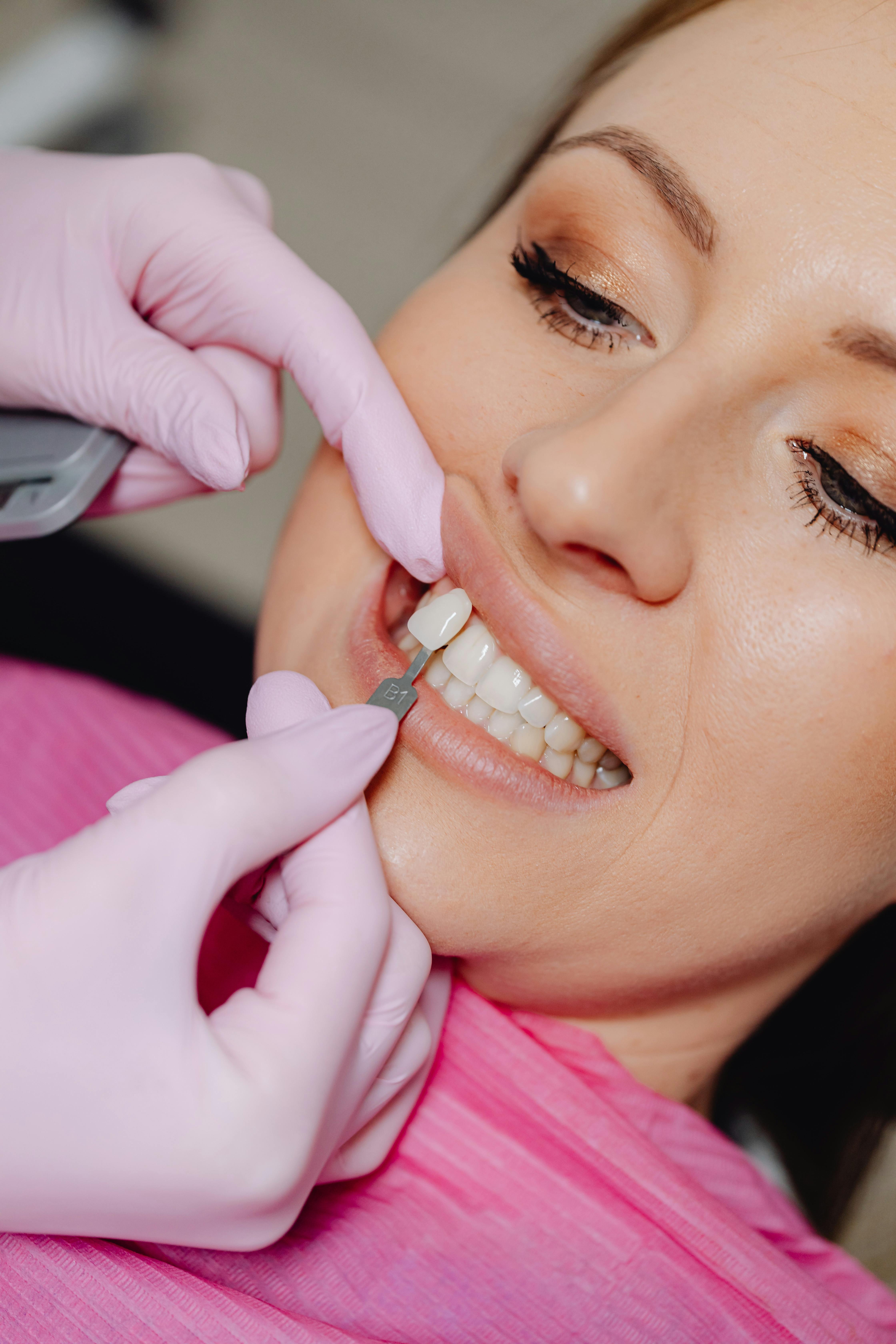 Dental Veneers at ScarboroSmiles Dental Clinic in Scarborough, ON | Best dentist in Scarborough.