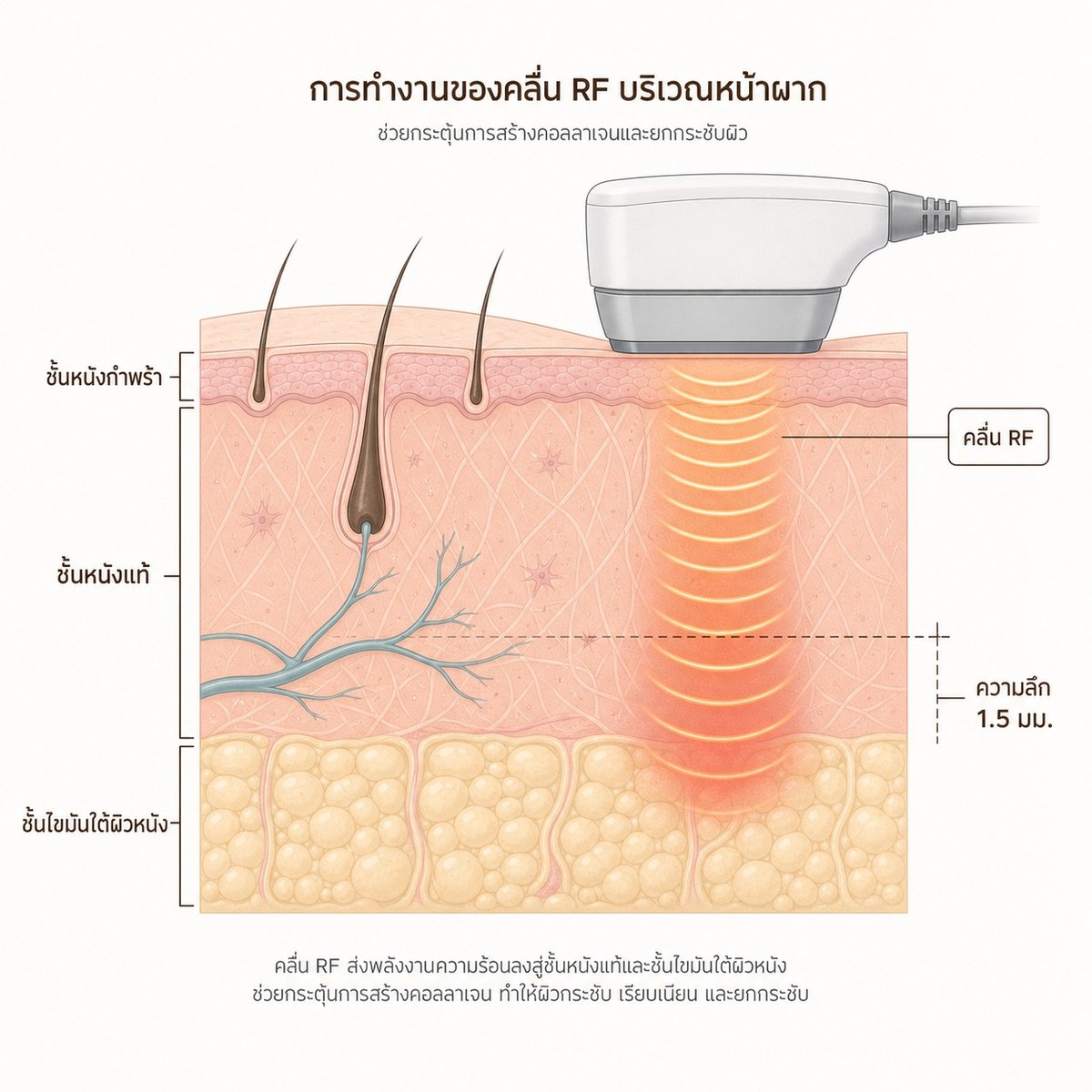 ภาพตัดขวางผิวหน้าผากแสดงคลื่น RF จาก Oligio X ส่งความร้อนลงชั้นหนังแท้