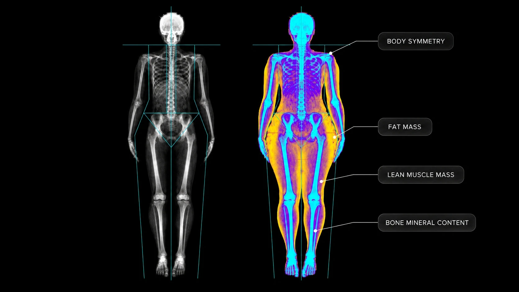 DEXA scan results showing the different attributes of the scan