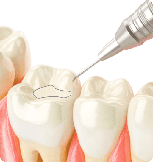3D Model of White fillings