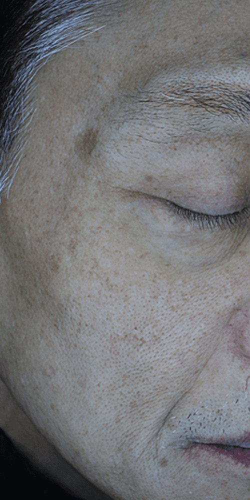 Pigmentation - After