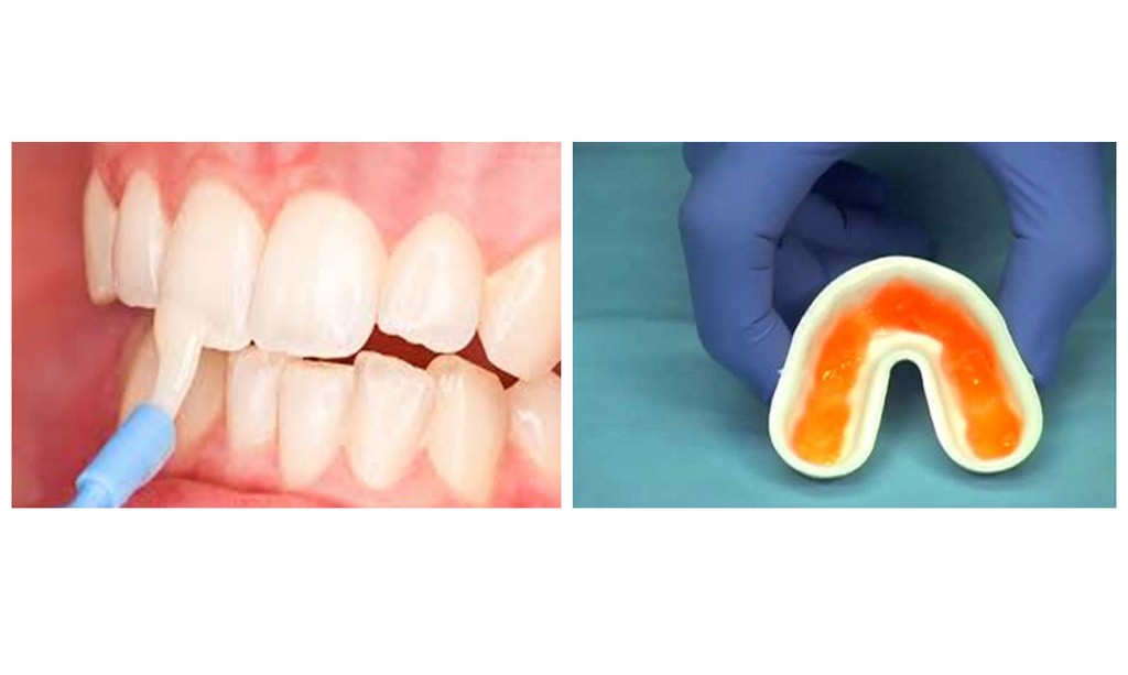 Custom-made mouth guard designed for night grinding prevention at Dentistree Kolkata.
