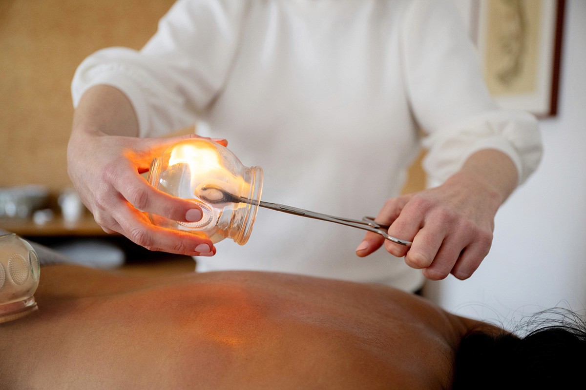 A close-up of Ruth performing fire cupping with professional precision, her hands working confidently to create a vacuum in the glass cup before placing it safely on the patient's back.
