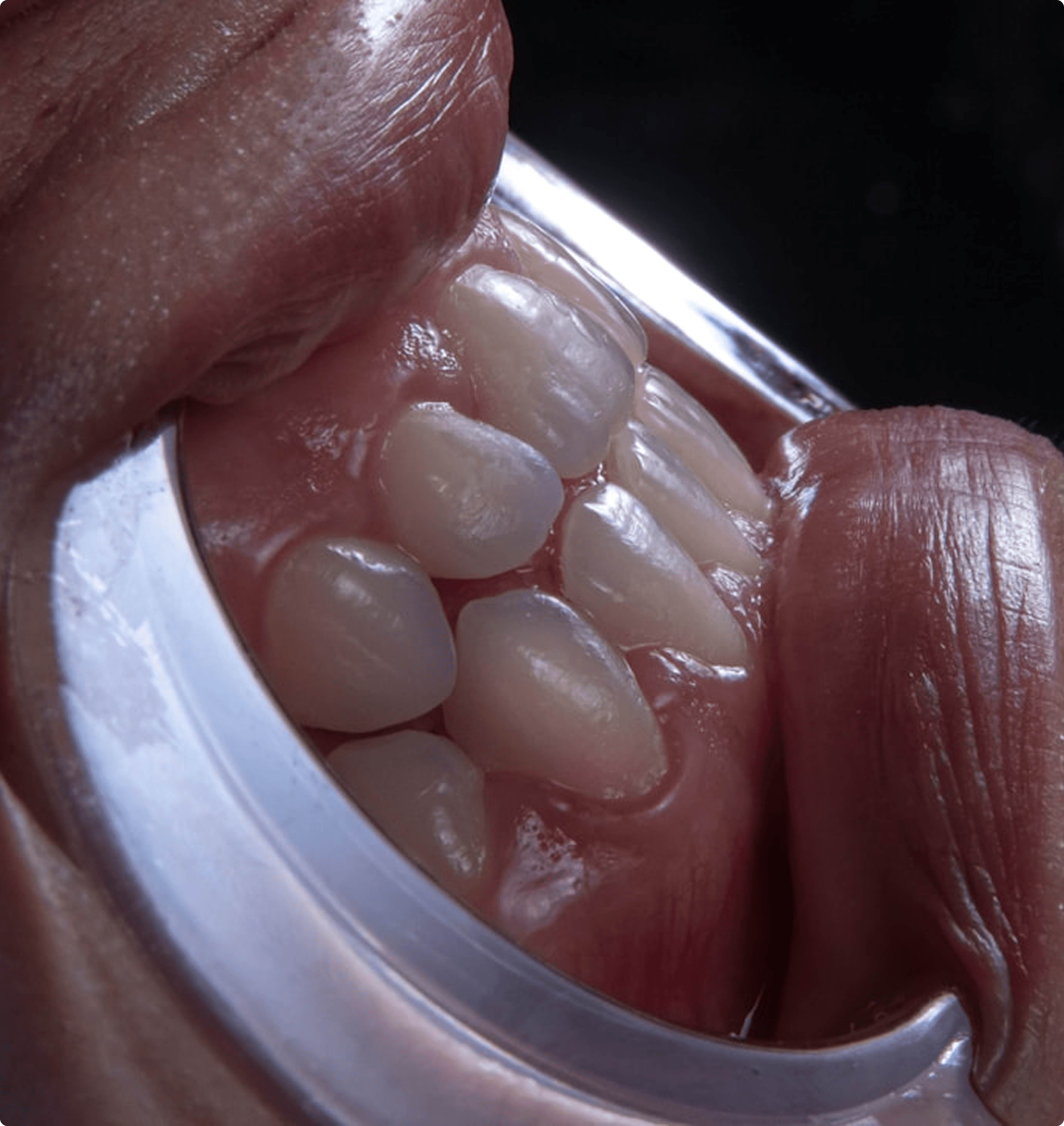 Close-up of crowded teeth with cheek retractor showing misalignment on one side of mouth.