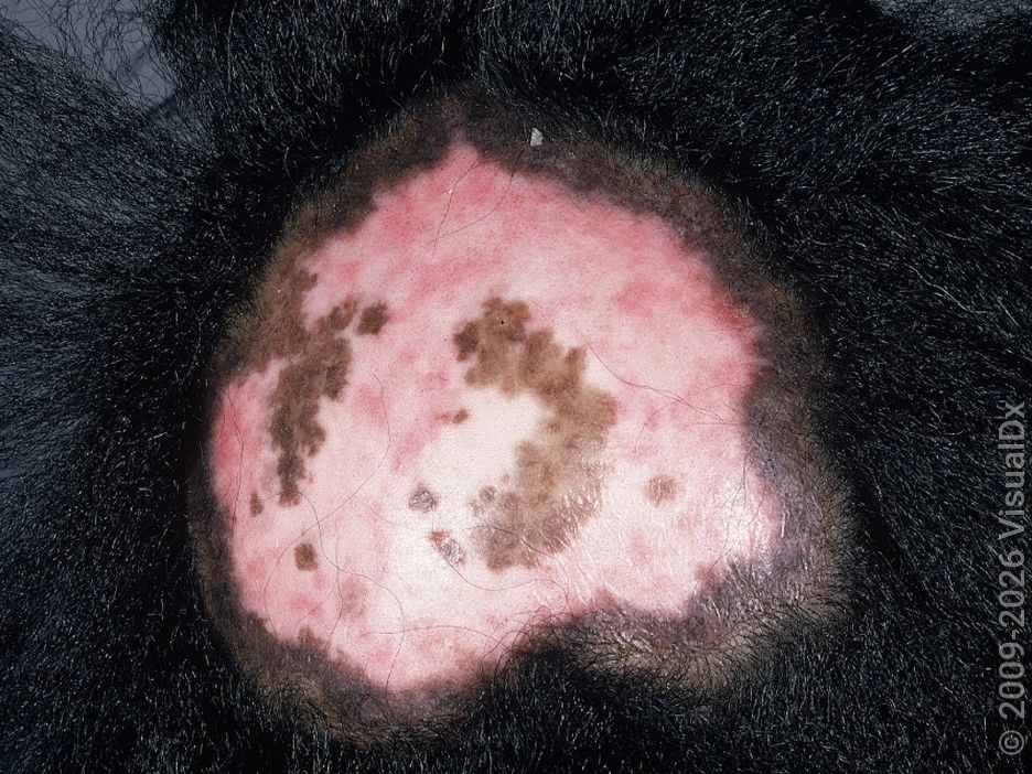 Discoid Lupus Erythematosus — image from NorCal Hair Doctor™'s existing website
