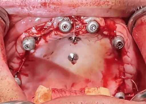 Digital Treatment Planning