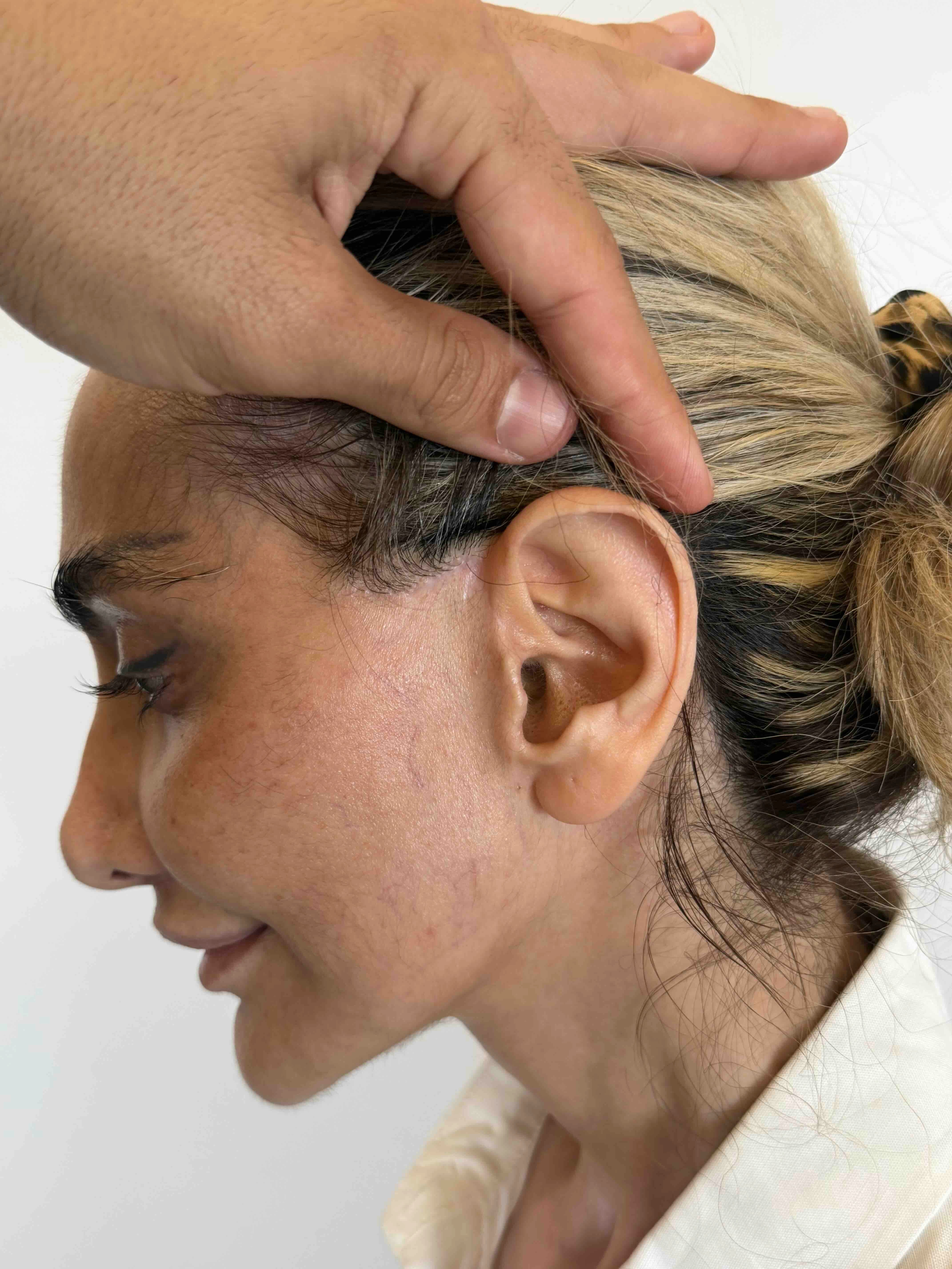 deep plane facelift scar