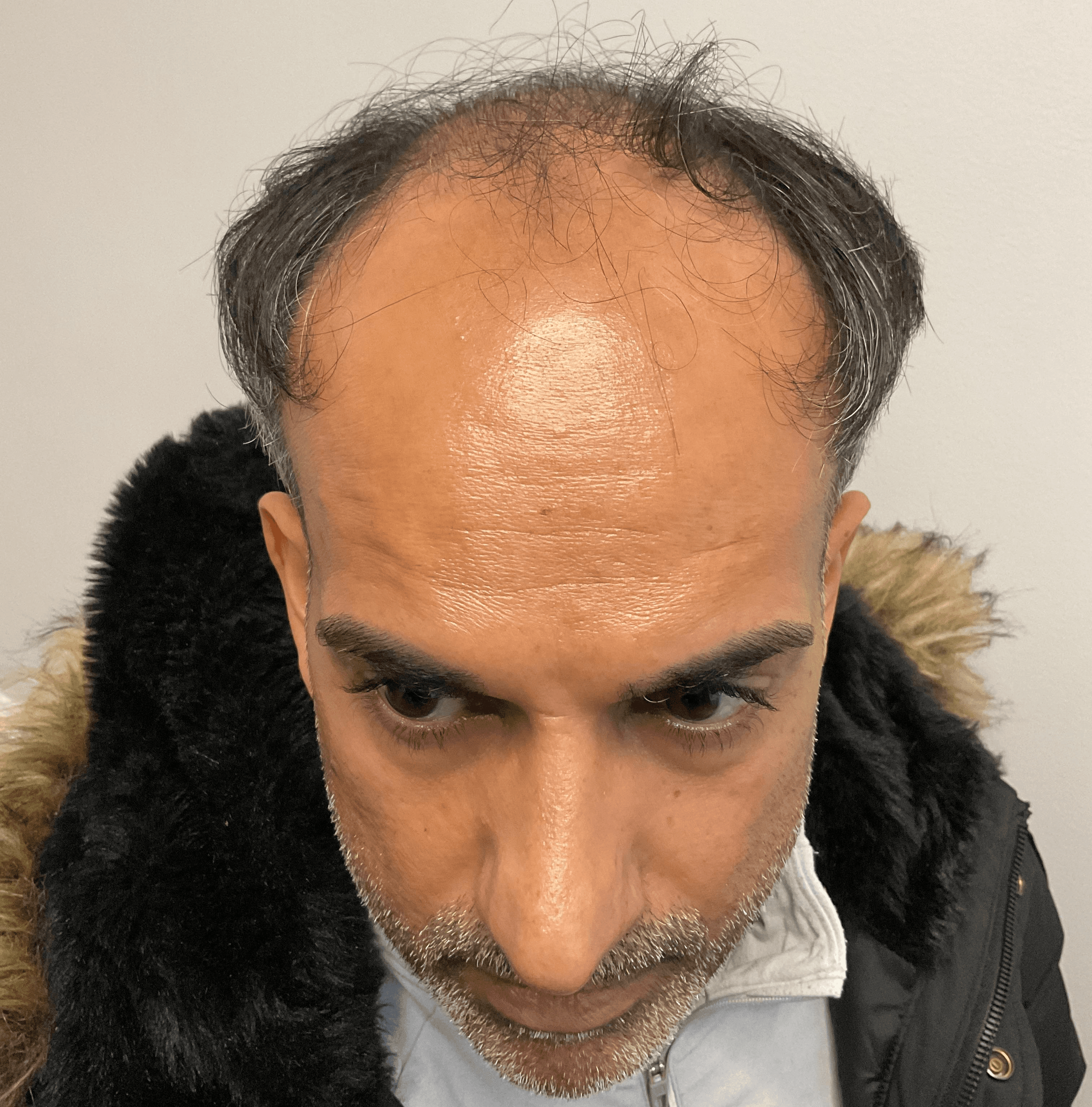 Before hair transplant – Aman's FUE Hair Transplant