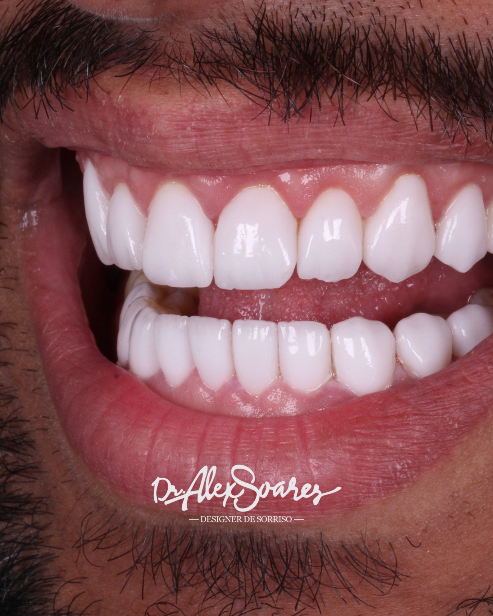 Lentes de porcelana · resultado final