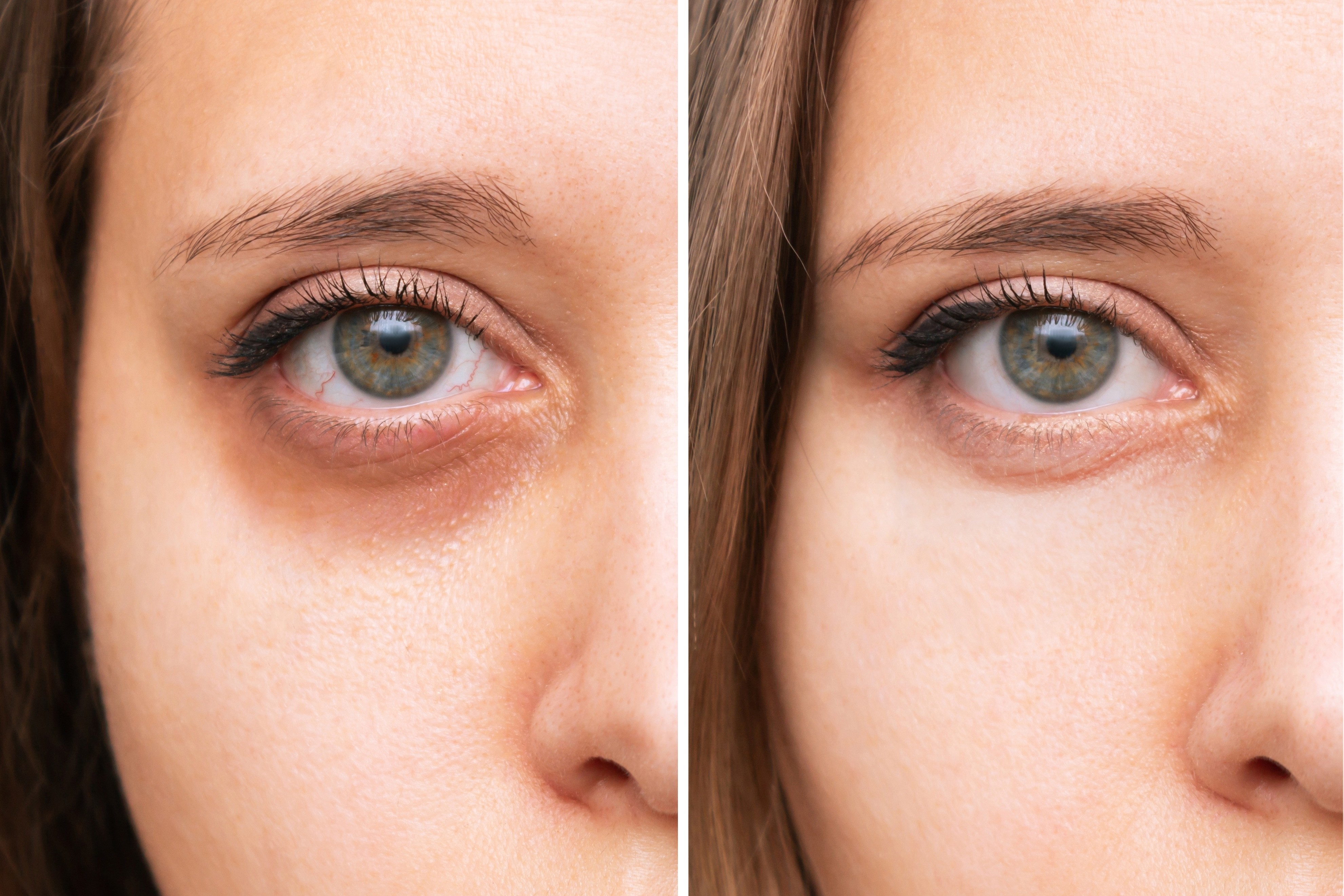 Before&After treatment for dark circles at bella medical in Abu Dhabi