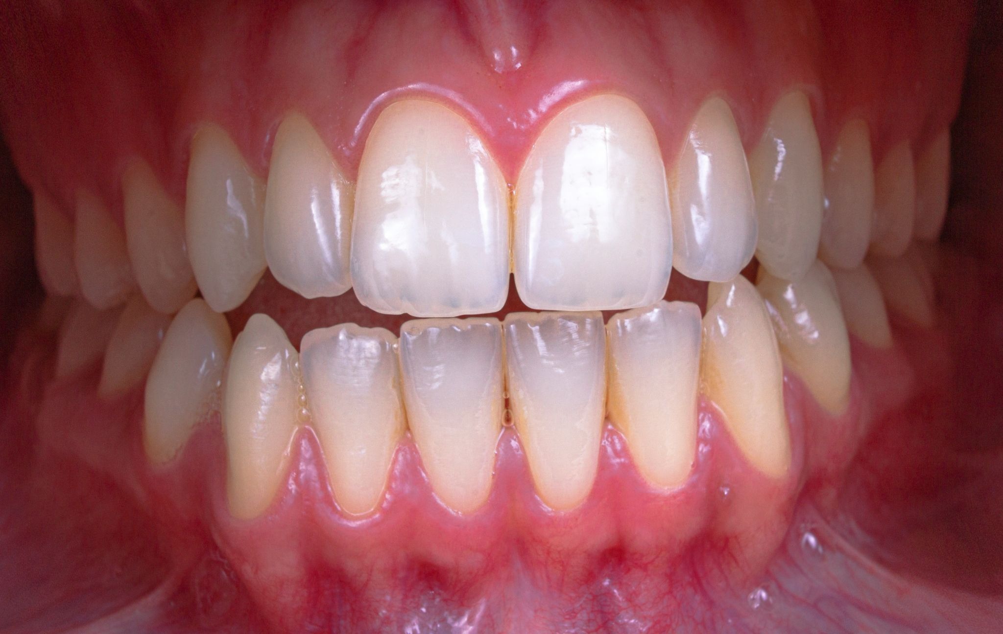 How to Fix Gap Between Teeth and Maintain Them&nbsp;