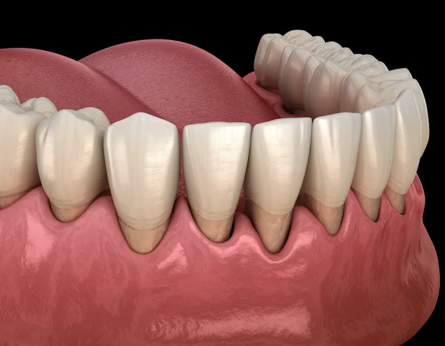 veneers