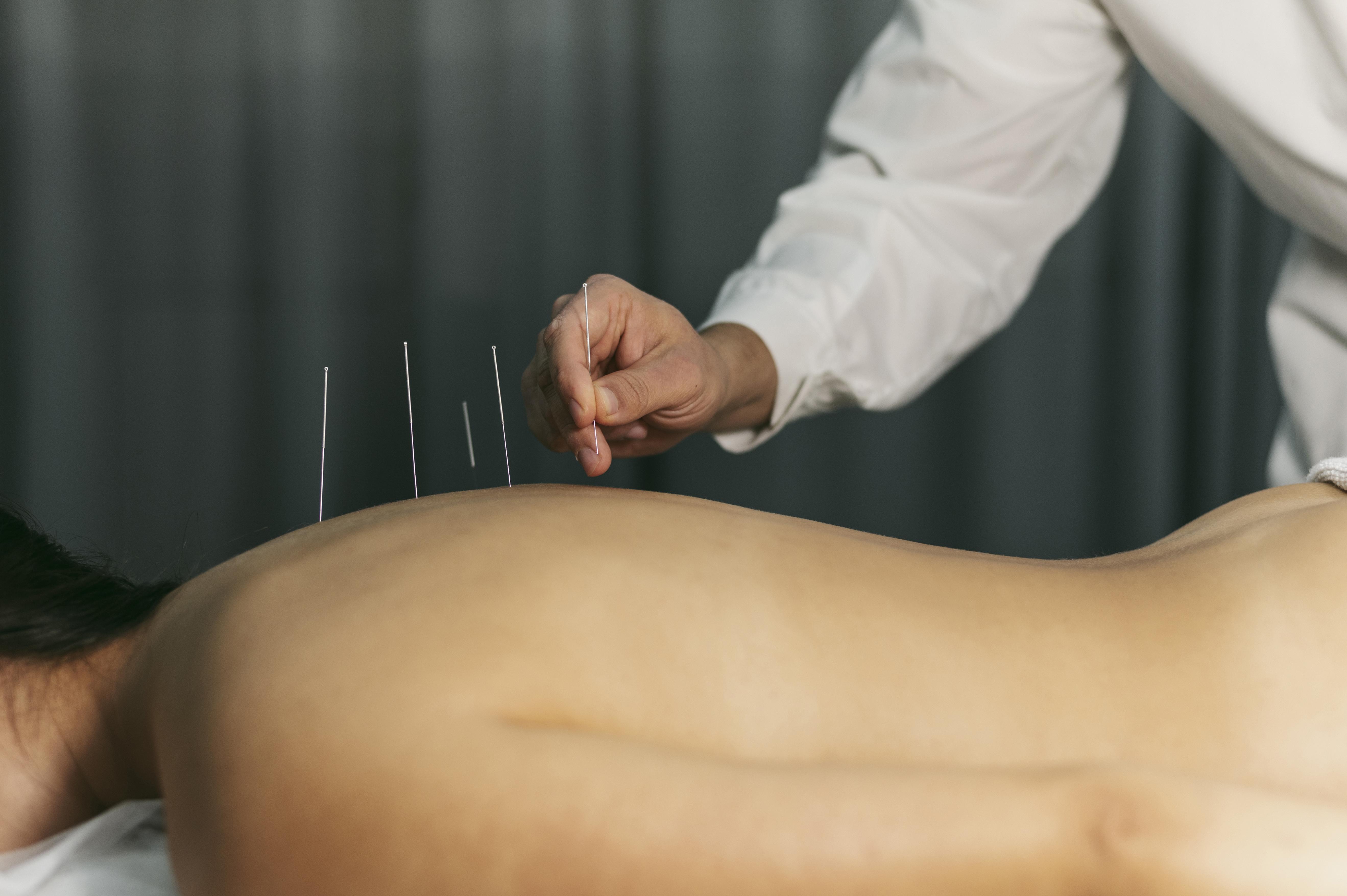 Back acupuncture