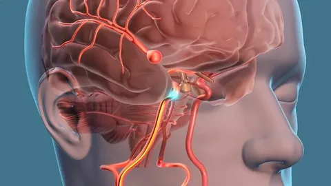 Representação Aneurisma Cerebral