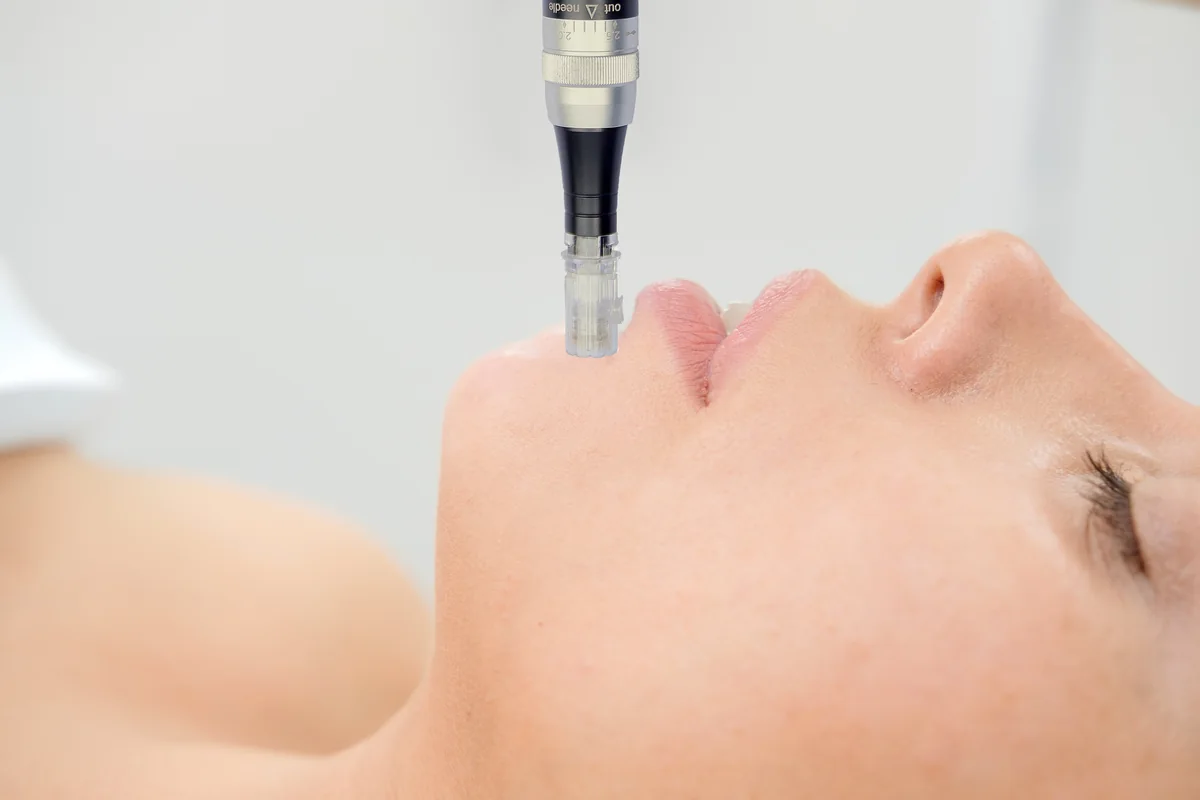 CytoPen Microneedling