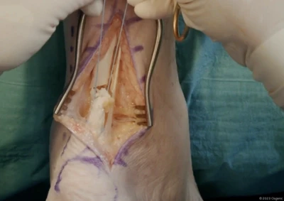 Achilles tendon repair