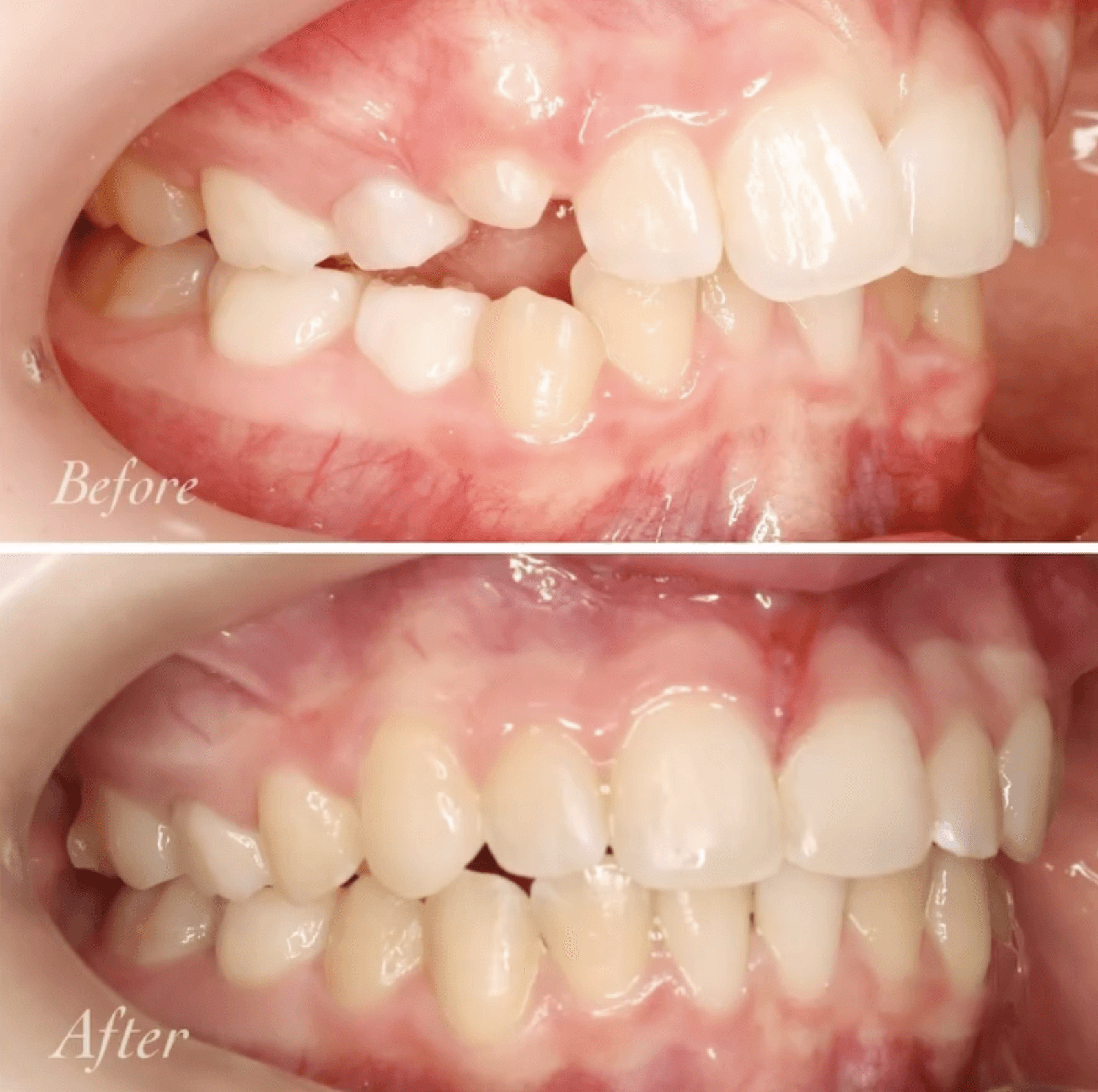 Side view image of invisalign before and after showing overbite correction and improved alignment at Invisalign Center in Dubai.