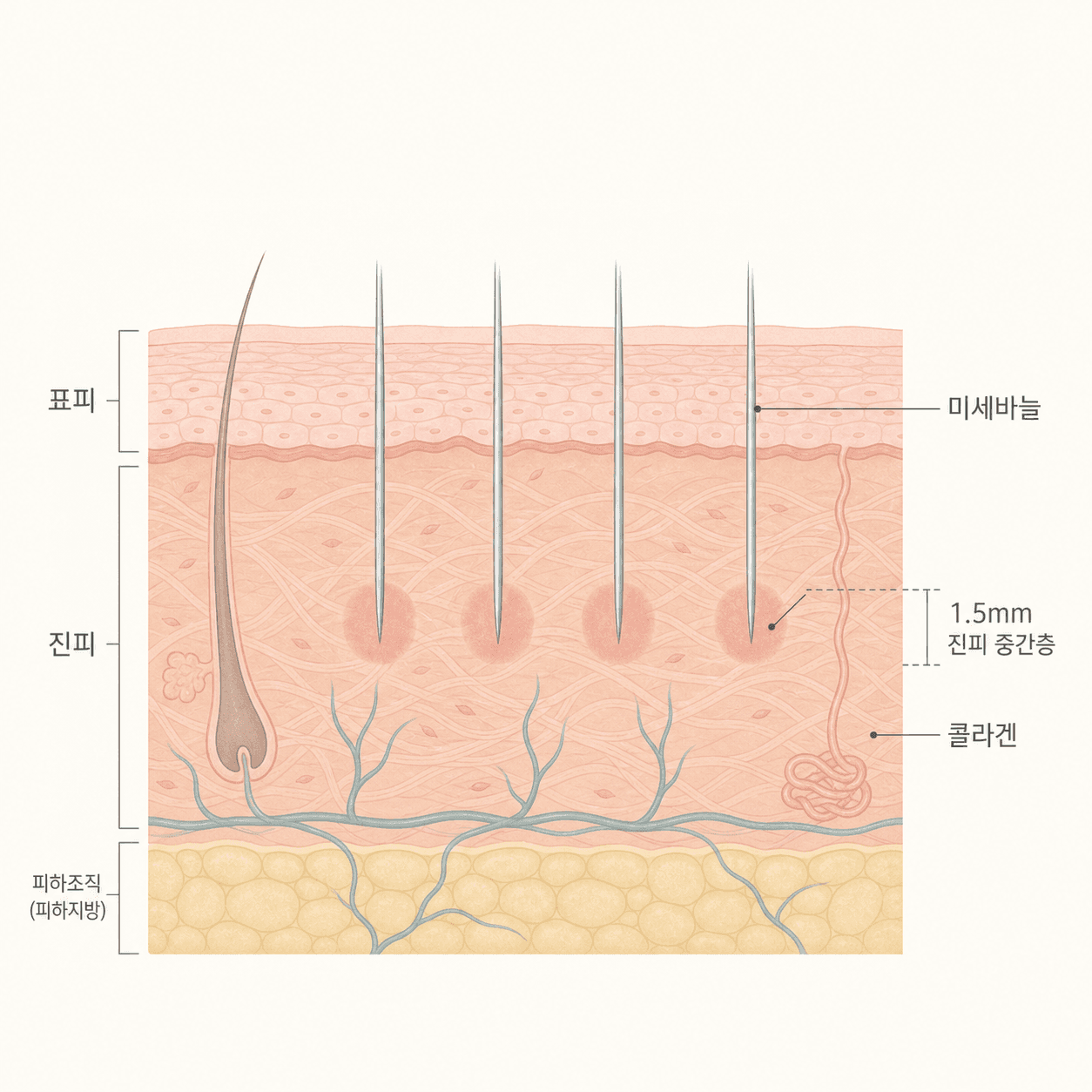 미세바늘이 진피에 고주파를 전달하는 구조