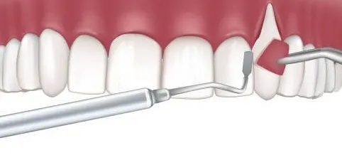 Intraoral Cameras