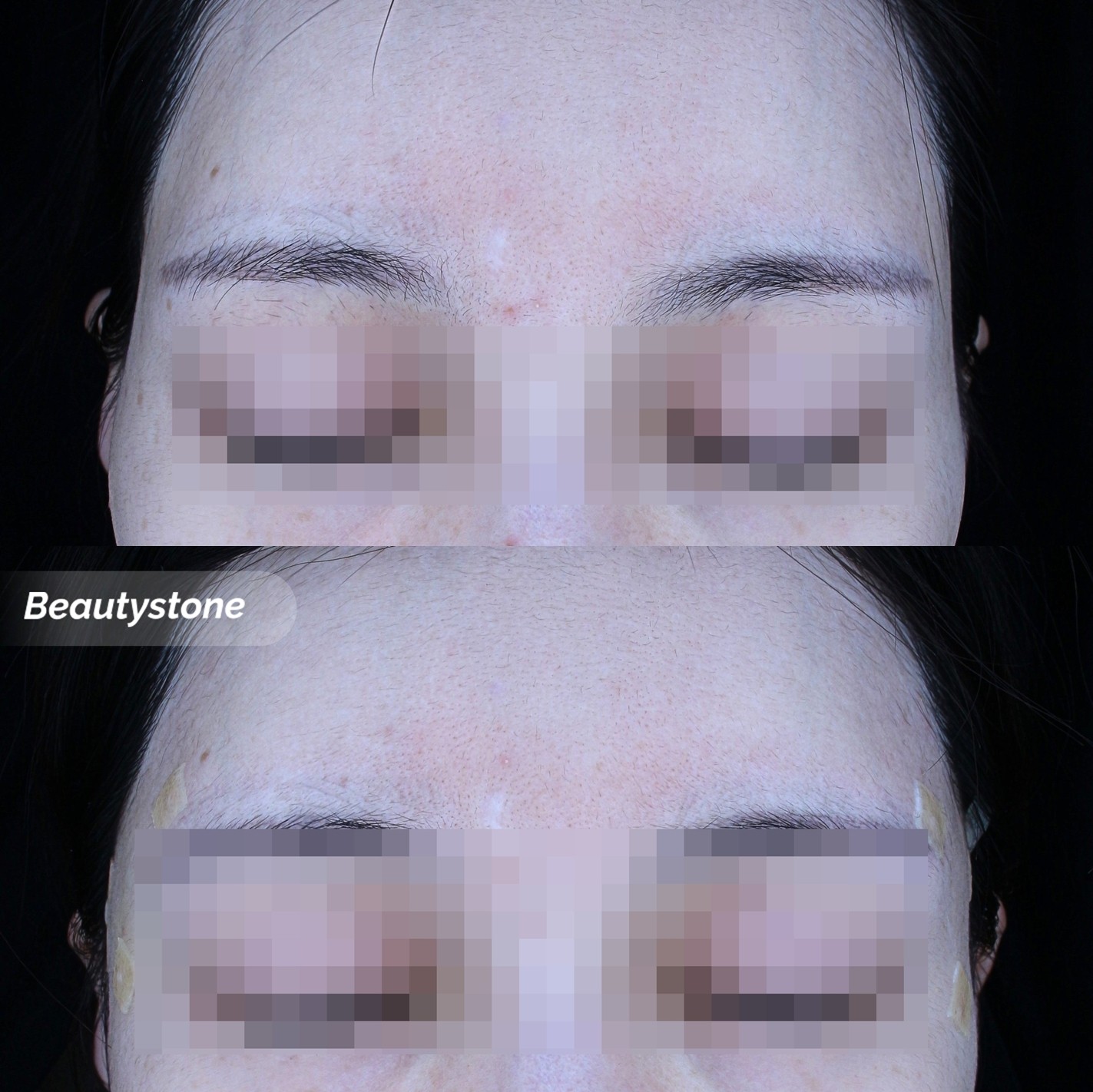 레디어스스킨부스터홍대피부과