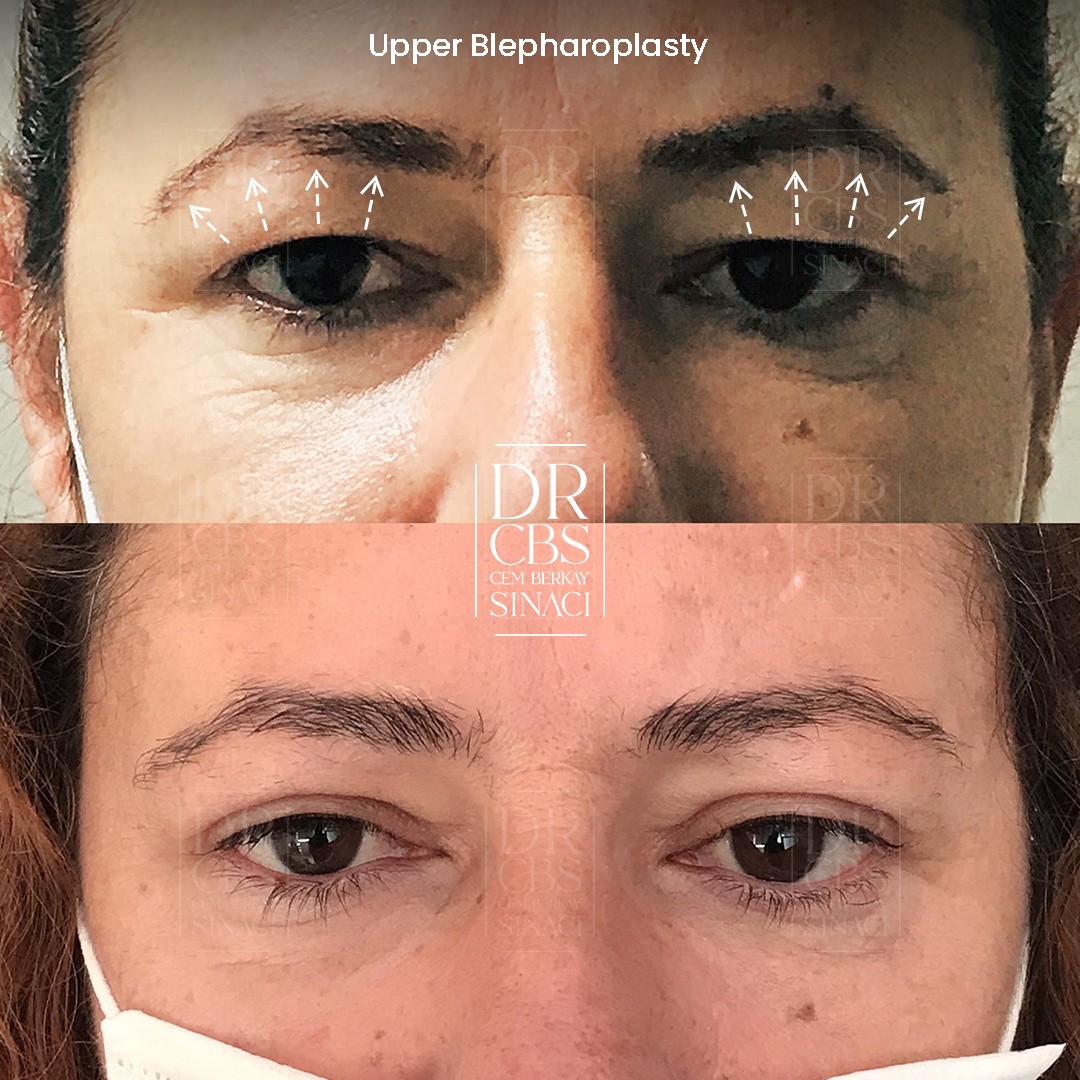 3 weeks upper blepharoplasty before after