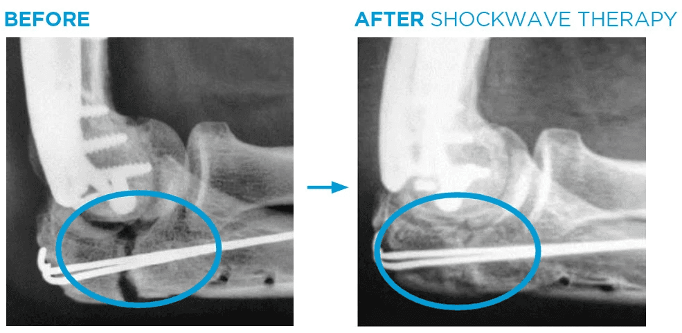 x-ray of Focal Shockwave Therapy