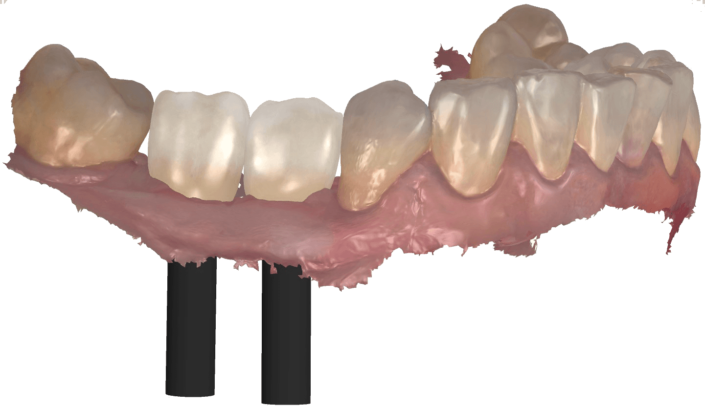 Digitálna modelácia zubných koruniek na implantátoch
