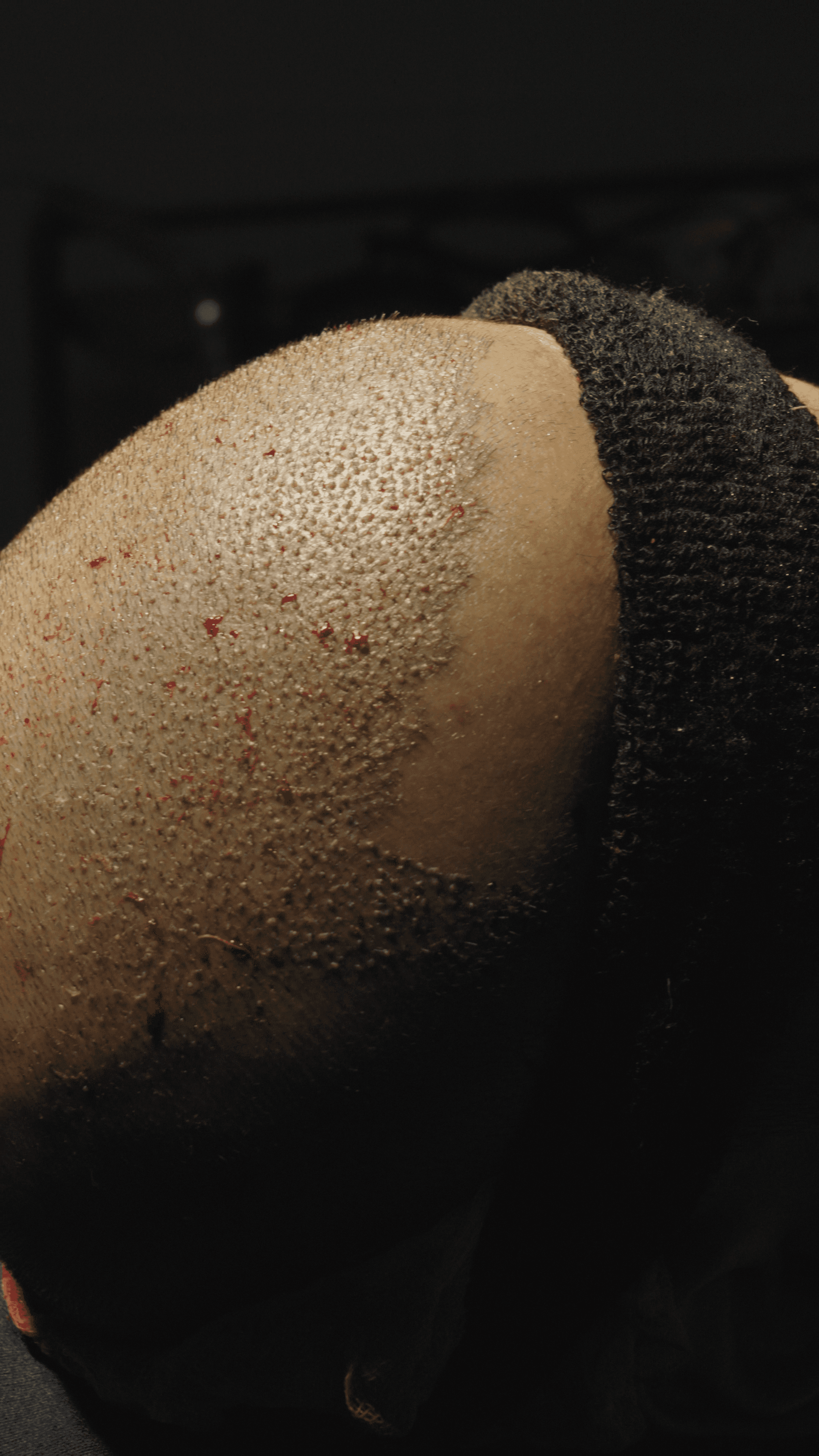 Dental professional performing procedure on patient using instruments and suction in clinic setting.