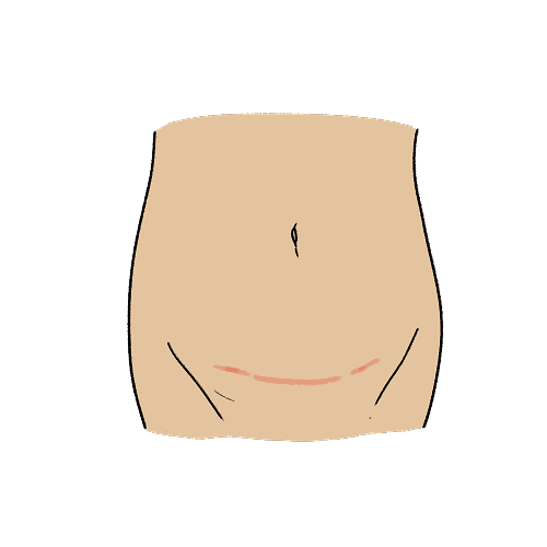An illustration of the caesarean incision site on the bikini line of an abdomen.