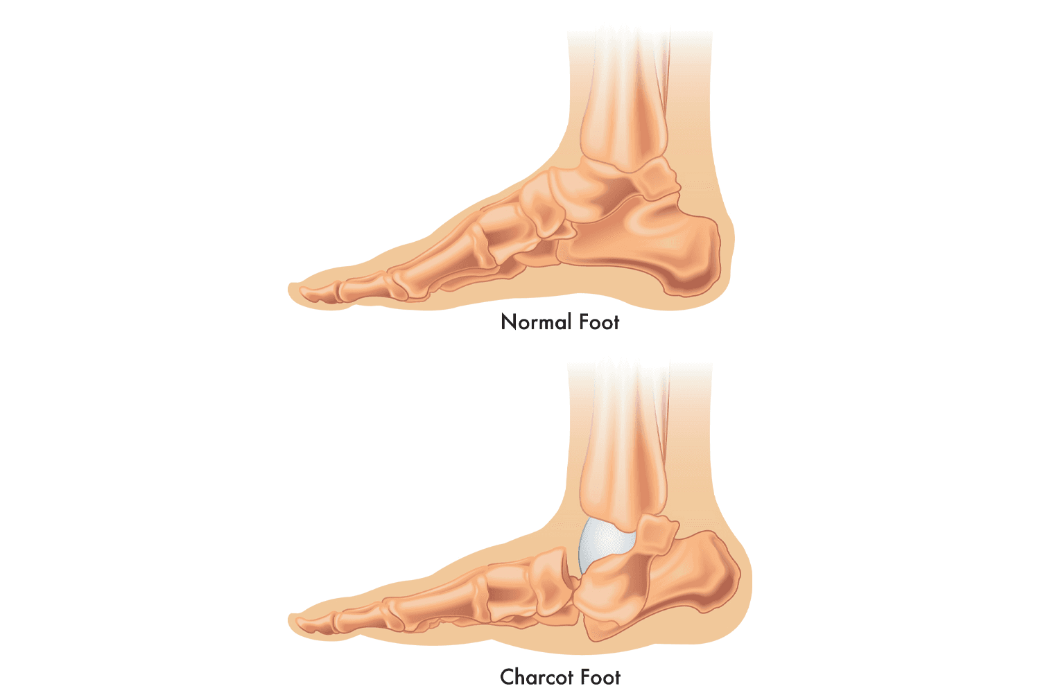 illustration of charcot foot reconstruction