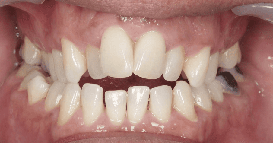 Before clear aligner treatment showing upper and lower teeth