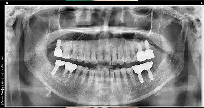 수복후 파노라마