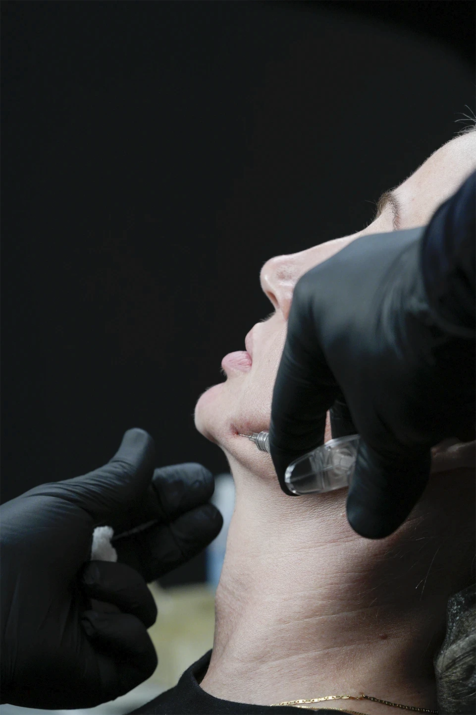 procedimento de preenchimento fullface durante worshop presencial