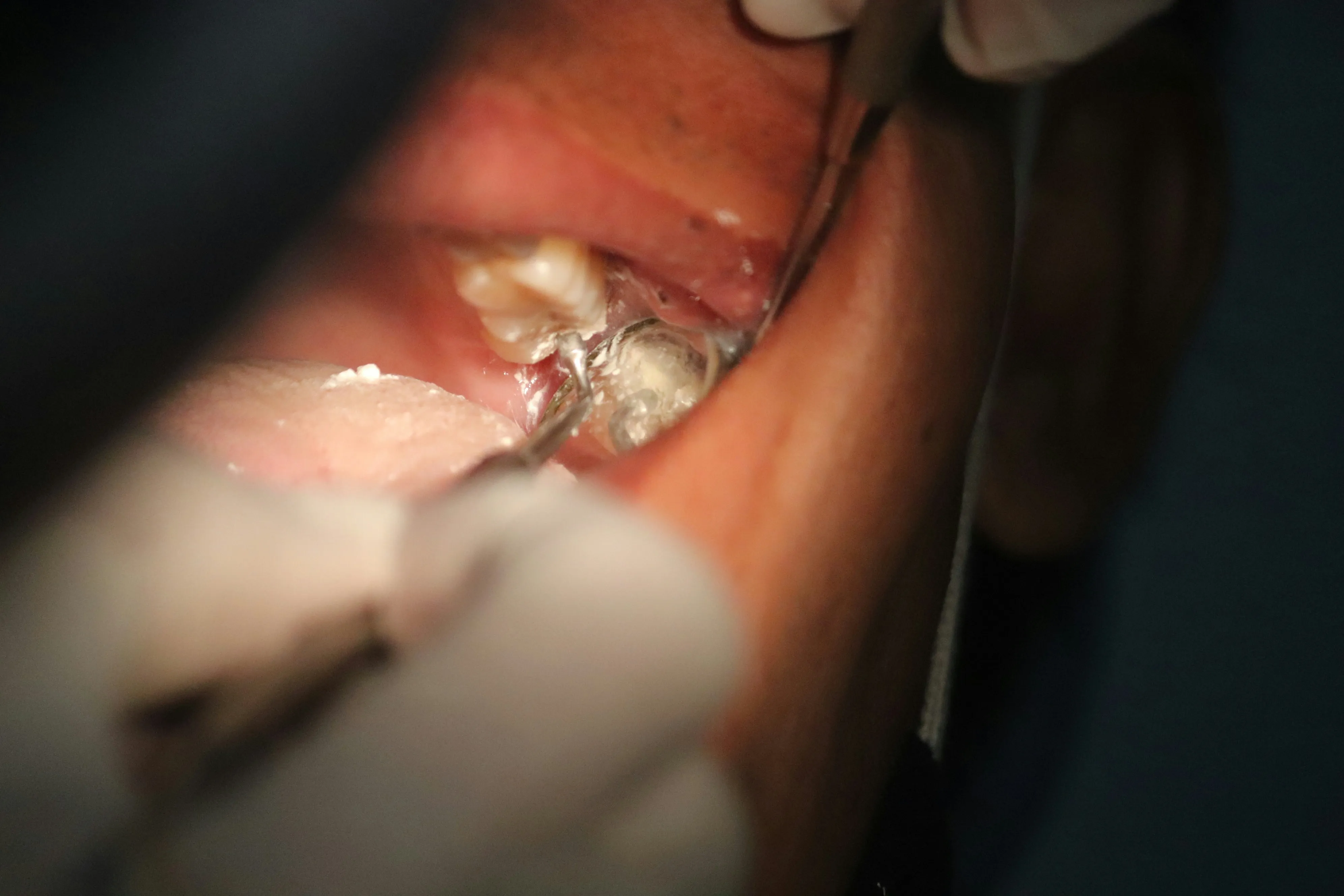 a close up of a person with a surgical instrument at Midtown Orthodontics | Best Orthodontist in Midtown Toronto, ON