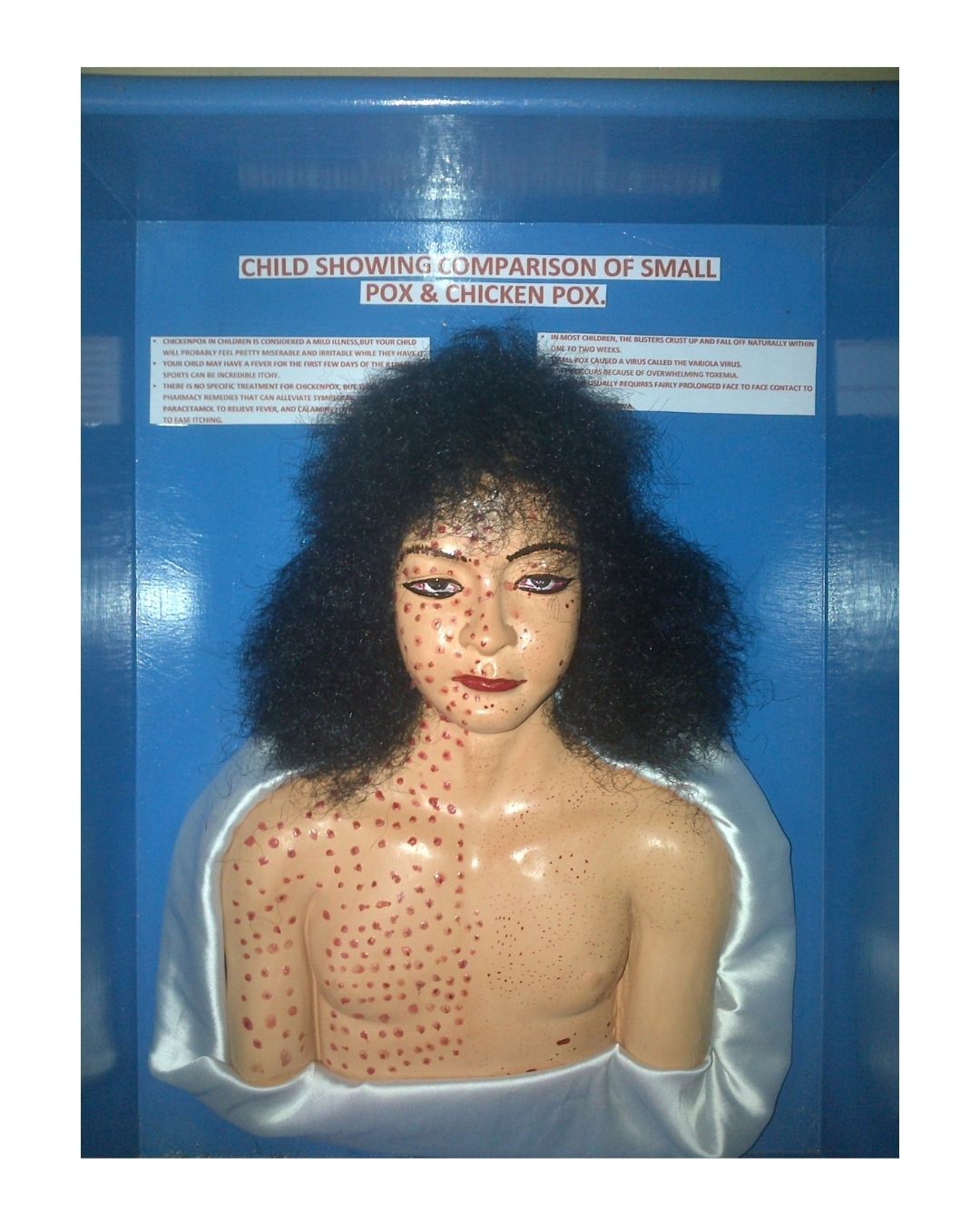 Child Comparison: Smallpox vs. Chickenpox Model