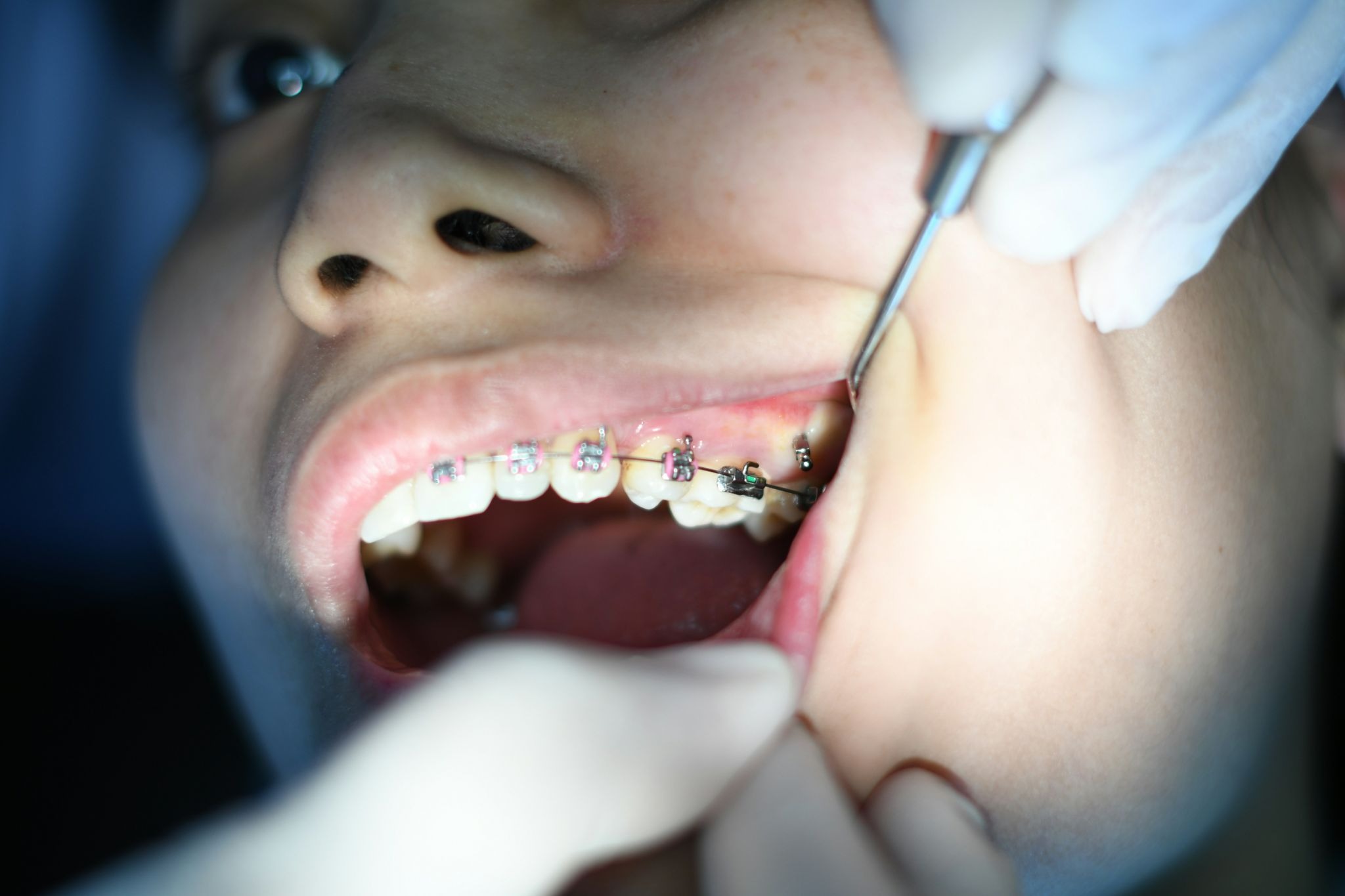 Benefits of getting teeth braces early