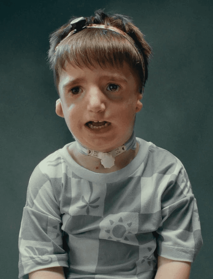 A young boy in a medical setting, wearing a shirt, with a curious expression and a slight medical apparatus on neck.