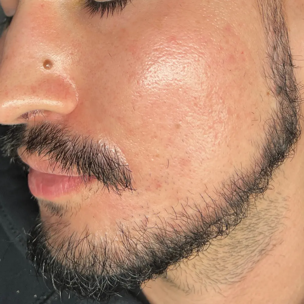 After men's facial at The Vancouver Aesthetician — beard irritation and redness resolved, pores visibly cleared and skin noticeably calmer and healthier