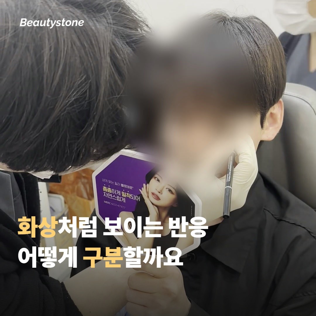 화상처럼 보이는 반응과 진짜 화상, 어떻게 구분할까요