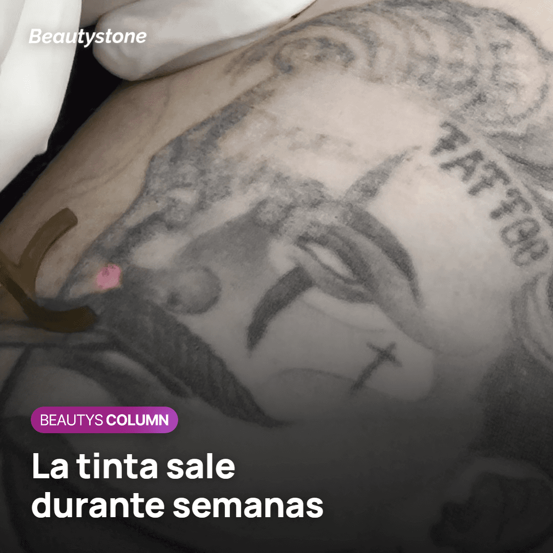 Por qué el tatuaje se aclara poco a poco tras PicoWay