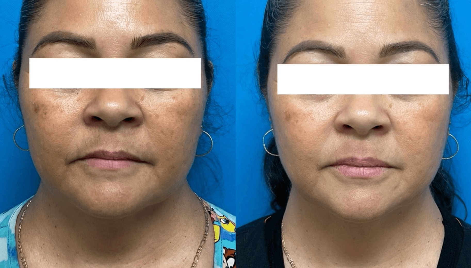 Viva Aesthetics RF microneedling before and after results.