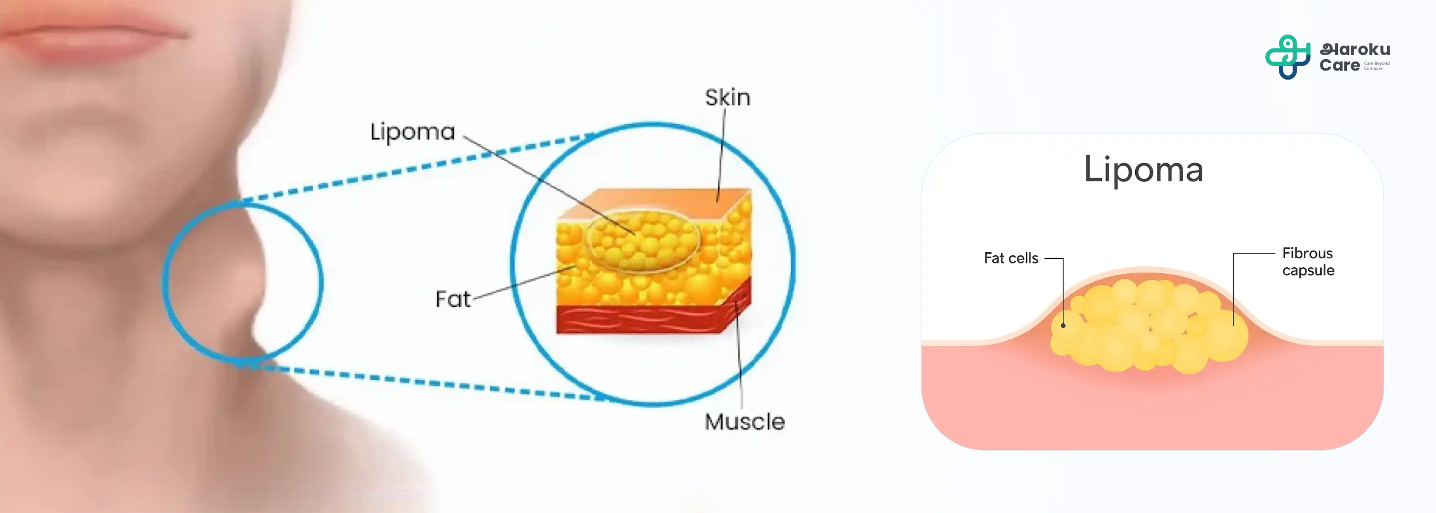 Diagram explaining excess gland and fat tissue in gynecomastia